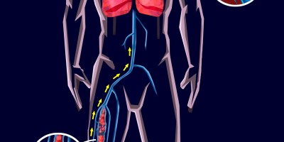 Tromboembolismo Venoso