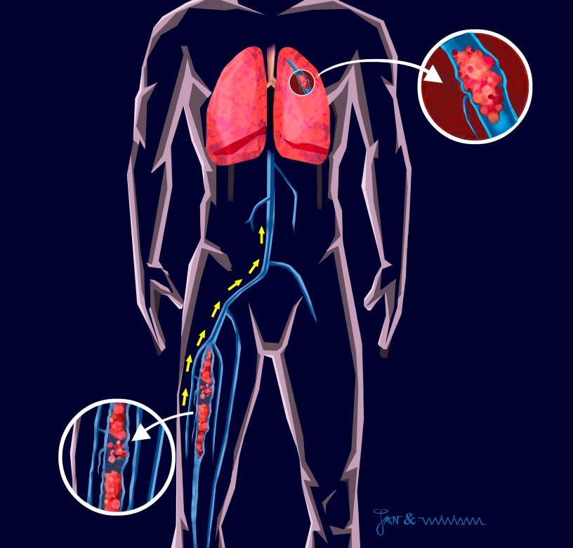 Tromboembolismo Venoso