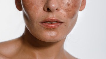 melasma-depilacao-laser