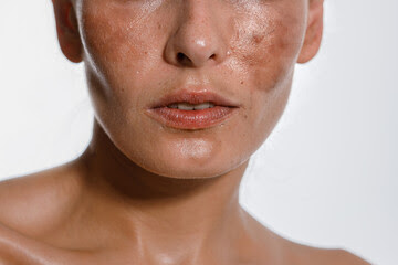 melasma-depilacao-laser